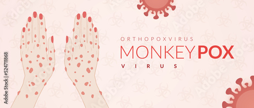 Monkeypox virus banner for awareness and alert against disease spread, Hand rash with monkeypox. Monkey Pox virus outbreak pandemic, pidemic from animals to humans. Monkeypox virus background