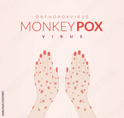Monkeypox virus banner for awareness and alert against disease spread, Hand rash with monkeypox. Monkey Pox virus outbreak pandemic, pidemic from animals to humans. Monkeypox virus background