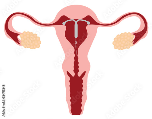 Intrauterine device (IUD) illustration. Uterus with IUD positioned