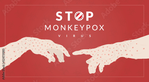 Monkeypox virus banner for awareness and alert against disease spread, Hand rash with monkeypox. Monkey Pox virus outbreak pandemic, epidemic from animals to humans. Monkeypox virus background