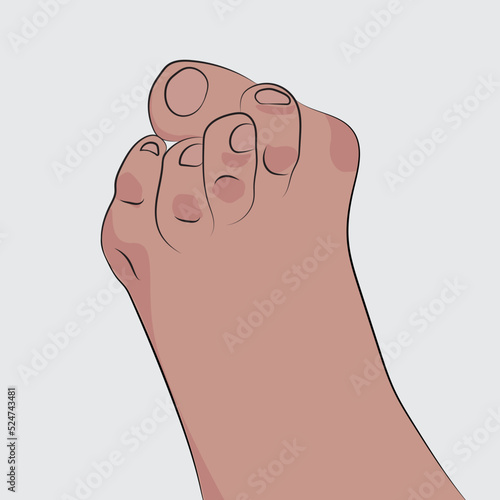 Bunion, a bony lump that forms at the joint at the base of the big toe. Vector diseases.