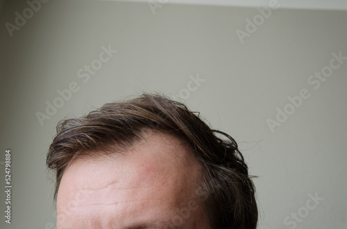 Hair loss man