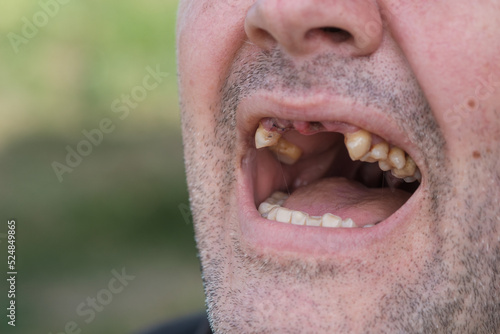 man's open mouth after upper teeth extraction