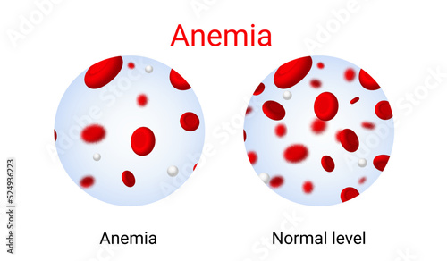 Anemia problem circulatory iron body diagram background. Anaemia biology blood isolated medical normal icon.