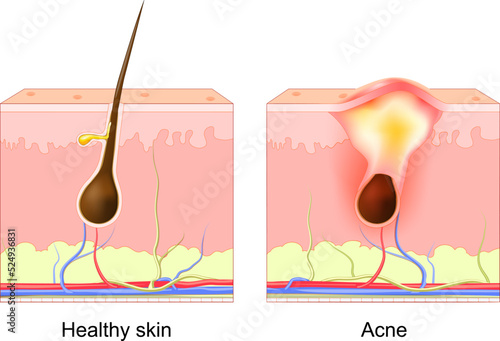 Acne pimple. normal hair follicle and clogged pore.