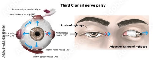 The clinical presentation of right third cranial nerve palsy. photo