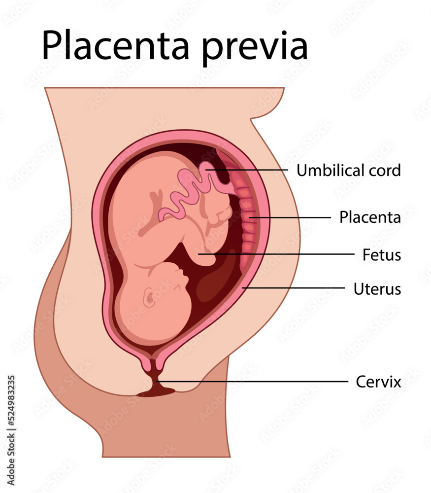 Obraz premium Placental previa. Fetus in Uterus During Pregnancy. Pregnancy women anatomy. Fetus with umbilical cord and placenta. Usual anatomical Placenta Location. Detailed medical vector illustration. 