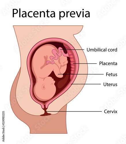 Placental previa. Fetus in Uterus During Pregnancy. Pregnancy women anatomy. Fetus with umbilical cord and placenta.
Usual anatomical Placenta Location. Detailed medical vector illustration.
