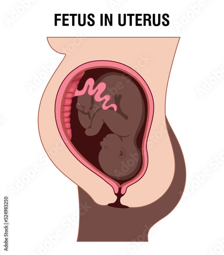 Placental previa. Fetus in Uterus During Pregnancy. Pregnancy women anatomy. Fetus with umbilical cord and placenta.
Usual anatomical Placenta Location. Detailed medical vector illustration.
