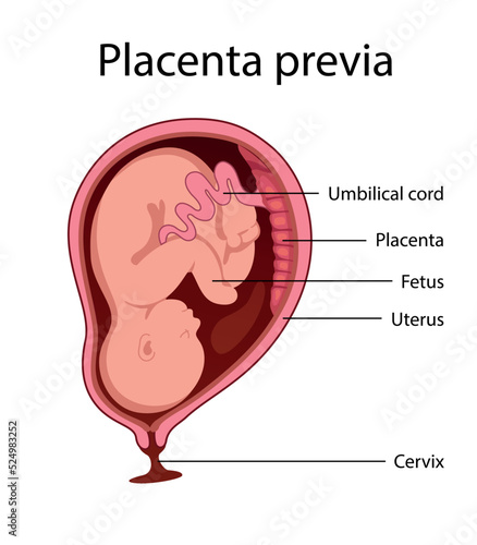 Placental previa. Fetus in Uterus During Pregnancy. Pregnancy women anatomy. Fetus with umbilical cord and placenta.
Usual anatomical Placenta Location. Detailed medical vector illustration.
