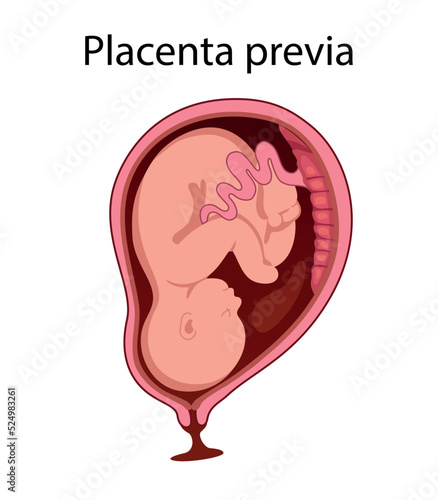 Placental previa. Fetus in Uterus During Pregnancy. Pregnancy women anatomy. Fetus with umbilical cord and placenta.
Usual anatomical Placenta Location. Detailed medical vector illustration.

