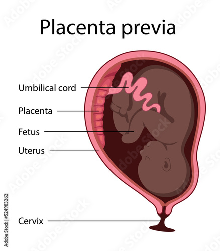 Placental previa. Fetus in Uterus During Pregnancy. Pregnancy women anatomy. Fetus with umbilical cord and placenta.
Usual anatomical Placenta Location. Detailed medical vector illustration.
