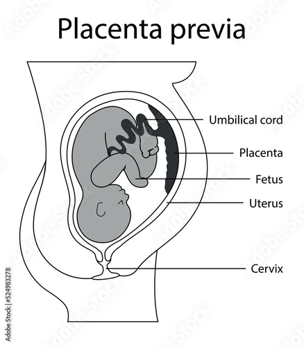 Placental previa. Fetus in Uterus During Pregnancy. Pregnancy women anatomy. Fetus with umbilical cord and placenta.
Usual anatomical Placenta Location. Detailed medical vector illustration.
