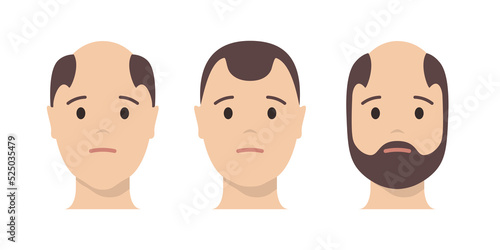 Hair loss man icon cartoon vector logo. Hair loss male scalp bald illustration
