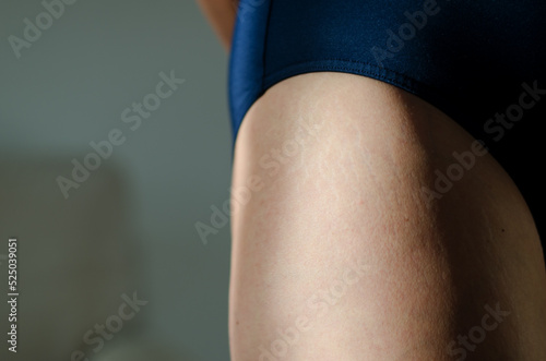 Stretch marks on legs after weight loss close up. Background and texture. Skin care. Active sport. Healthy lifestyle. Beauty. 