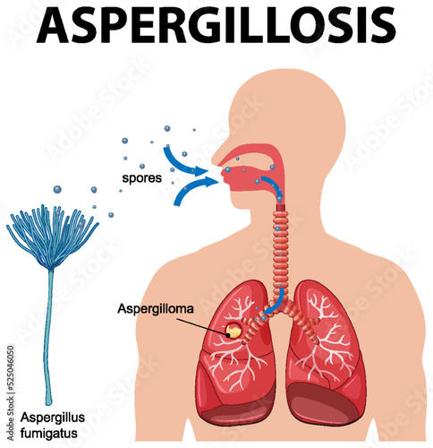 Diagram showing aspergillus infection