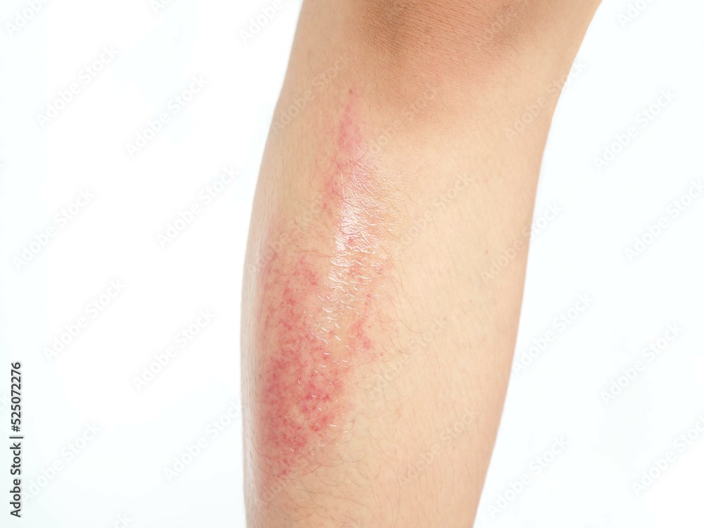 Young woman have bruise on leg from accident on white background. Closeup photo, blurred. Young woman have bruise on leg from accident on white background. Closeup photo, blurred.
