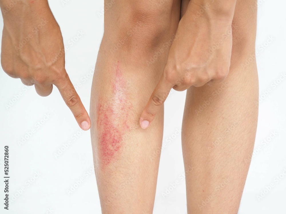 Asian woman pointing to bruises on leg on white background. Closeup photo, blurred. Asian woman pointing to bruises on leg on white background. Closeup photo, blurred.