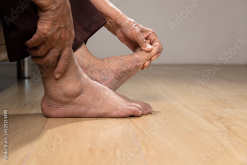 Senior woman massage foot with painful swollen gout inflammation © toa555