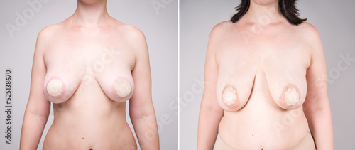 Before and after breastfeeding concept, woman with large saggy breasts after pregnancy and breastfeed photo