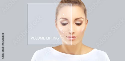 Concept of rejuvenation.Volume lifting.Hyaluronic acid injections for specific areas.