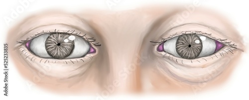 The normal diameter of pupil, the dilated pupil in midbrain lesion and the pinpoint pupil in pontine lesion. photo