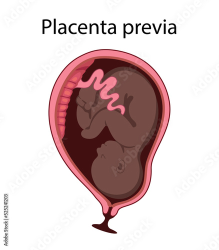 Different Placental Locations.  Fetus in Uterus During Pregnancy. Normal, top, low previa and front position.  
Pathology. Detailed medical vector illustration.
