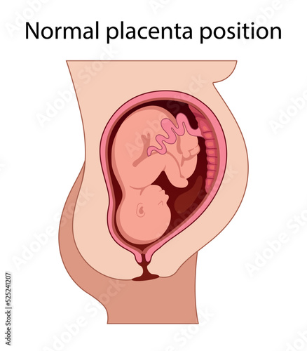 Different Placental Locations.  Fetus in Uterus During Pregnancy. Normal, top, low previa and front position.  
Pathology. Detailed medical vector illustration.

