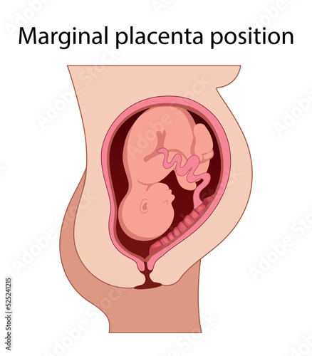 Different Placental Locations.  Fetus in Uterus During Pregnancy. Normal, top, low previa and front position.  
Pathology. Detailed medical vector illustration.
