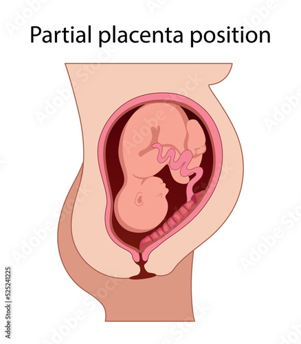 Different Placental Locations.  Fetus in Uterus During Pregnancy. Normal, top, low previa and front position.  
Pathology. Detailed medical vector illustration.
