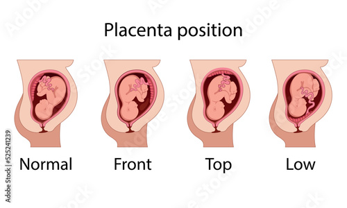 Different Placental Locations.  Fetus in Uterus During Pregnancy. Normal, top, low previa and front position.  
Pathology. Detailed medical vector illustration.
