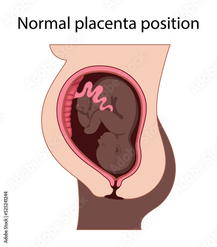 Different Placental Locations.  Fetus in Uterus During Pregnancy. Normal, top, low previa and front position.  
Pathology. Detailed medical vector illustration.
