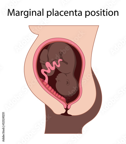 Different Placental Locations.  Fetus in Uterus During Pregnancy. Normal, top, low previa and front position.  
Pathology. Detailed medical vector illustration.
