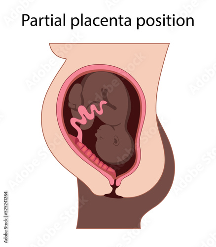 Different Placental Locations.  Fetus in Uterus During Pregnancy. Normal, top, low previa and front position.  
Pathology. Detailed medical vector illustration.
