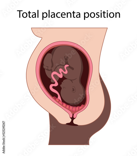 Different Placental Locations.  Fetus in Uterus During Pregnancy. Normal, top, low previa and front position.  
Pathology. Detailed medical vector illustration.
