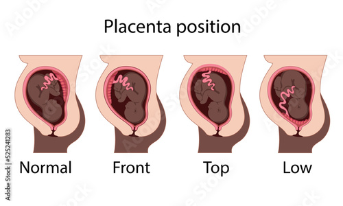 Different Placental Locations.  Fetus in Uterus During Pregnancy. Normal, top, low previa and front position.  
Pathology. Detailed medical vector illustration.
