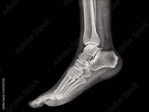 Schilderij op canvas An x-ray of the human foot and ankle