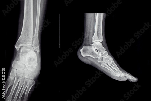 X-rays of the human foot from two angles © sebi_2569