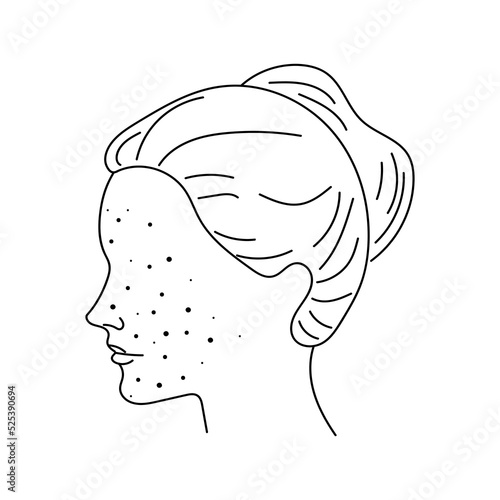 Girl with pimples on her face. Linear head of a woman with pimples. Woman with acne, pimples, rash linear pictogram. Dermatological problem, allergy, inflammation skin outline icon. vector 