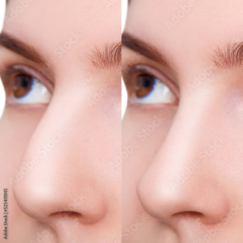 Portrait of female nose before and after plastic surgery.