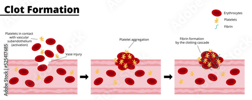 Clot formation process after a bleeding vascular injury. Platelet aggregate formation. Formation of fibrin by the clotting cascade. Vector illustration. Didactic illustration.
 photo