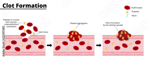 Clot formation process after a bleeding vascular injury. Platelet aggregate formation. Formation of fibrin by the clotting cascade. Vector illustration. Didactic illustration.
