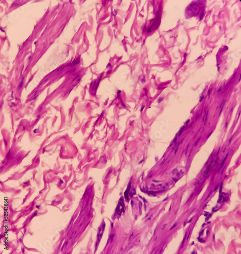 Scrotal wall(biopsy): Calcinosis cutis, show skin, subepithelial tissue of extensive calcification. histology image analyzed by light microscope. photo