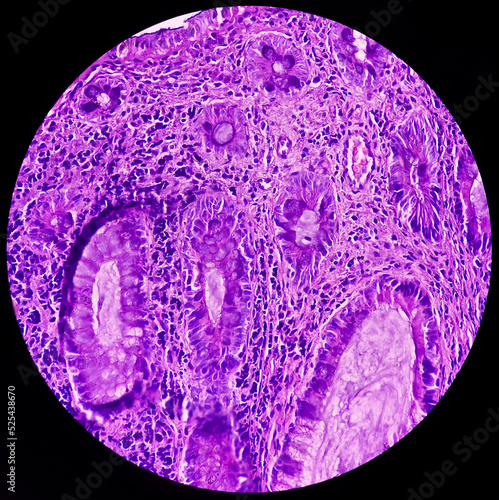 Wound area tissue: Foreign body reaction, show soft tissue, fatty tissue and fibrocollagenous tissue. 40x microscopic view. photo