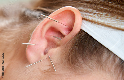 Beautiful woman relaxing on a bed having acupuncture treatment with needles in and around her ear. Alternative Therapy concept photo