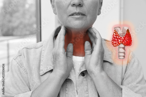 Mature woman with thyroid gland disease indoors photo