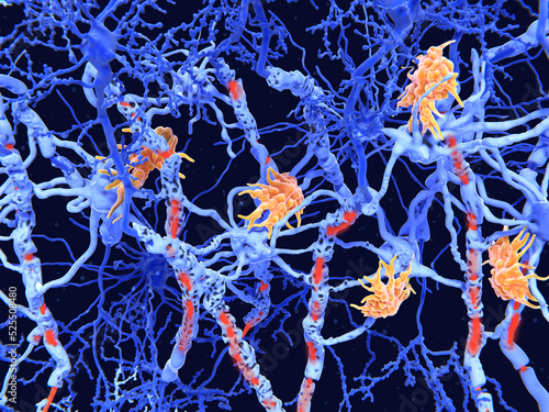 Multiple sclerosis (MS): microglia cells damage the myelin sheath of neuron axons. The demyelinated axons are depicted red. photo