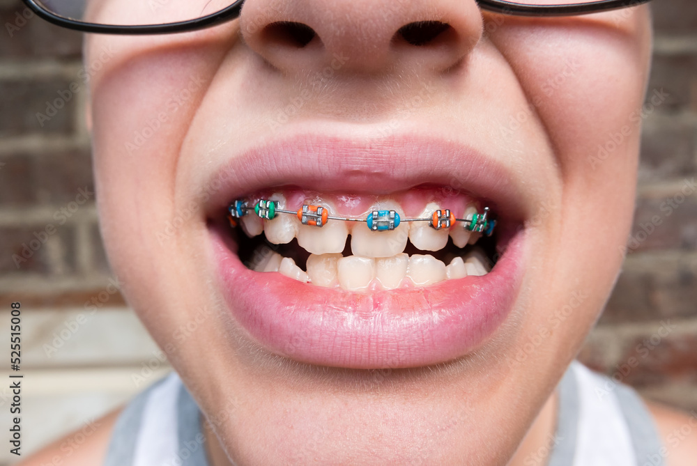 Fototapeta premium Young boy with abnormal teeth position and correction with metal braces. Open mouth close up