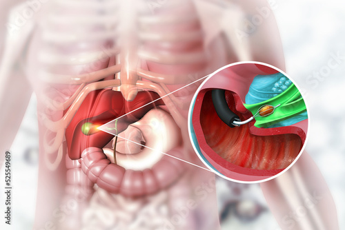 Gallstones removing in the Gallbladder. 3d illustration photo