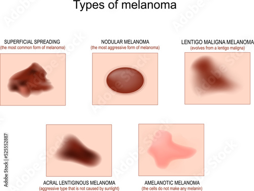 Types of melanoma